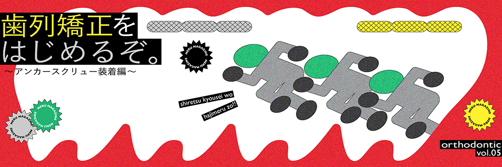 歯列矯正をはじめるぞ。〜アンカースクリュー装着編〜